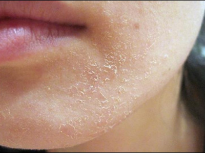 Nguyên nhân và cách khắc phục da khô bong tróc